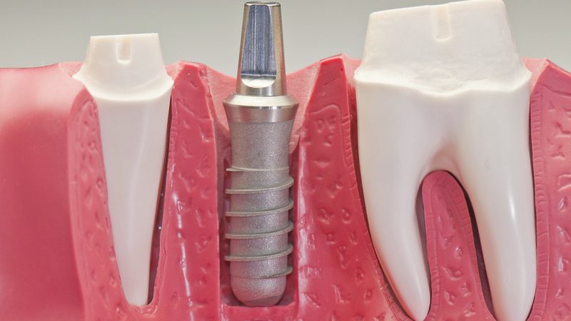 Implants dentaires : calendrier réel et nombre de voyages